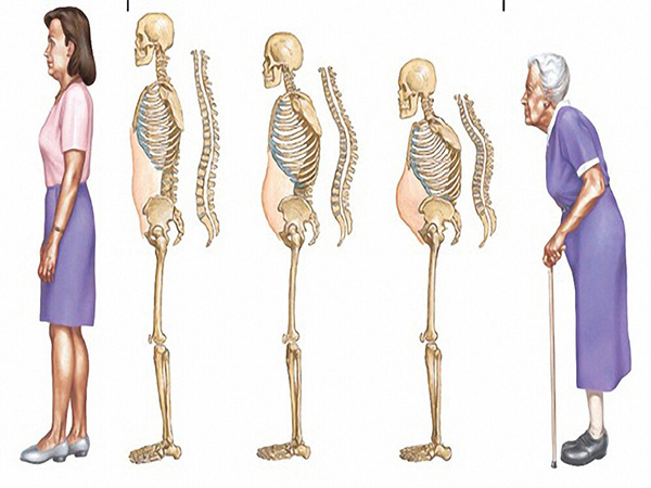 Quá trình lão hóa xương ở người già